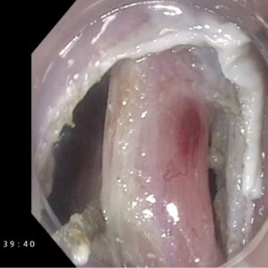 Jornada de entrenamiento en disección endoscópica y endoscopia del tercer espacio